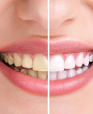 Teeth Whitening Near Me in Camarillo, CA